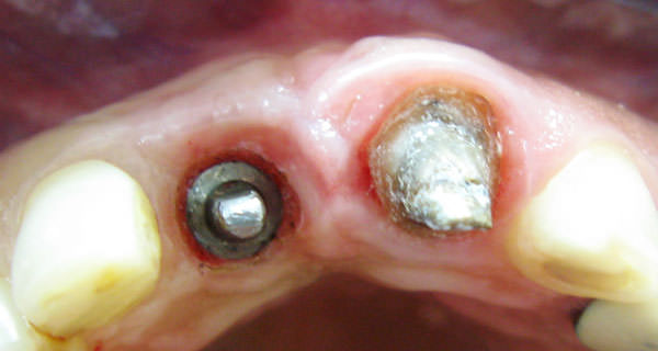 Figura 3 Ocho meses post-operatorios. Se nota aumento del espesor de tejido queratinizado en sentido vestíbulo - palatino a expensas del procedimiento.