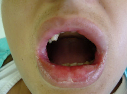 Figura 1 Lesiones de mucositis oral en labio.