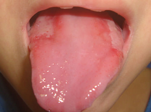Figura 2 Lesiones de mucositis oral en lengua.