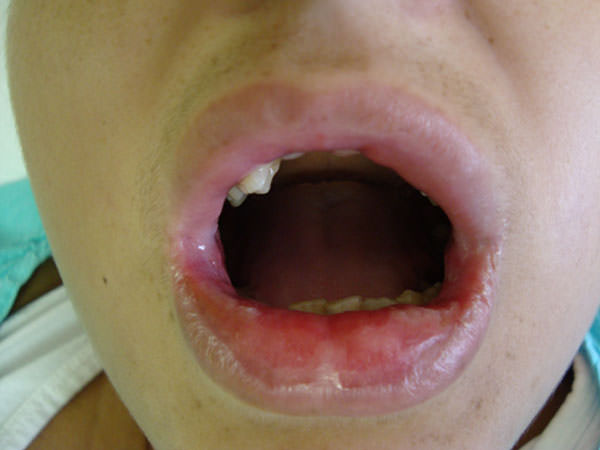Figura 1 Lesiones de mucositis oral en labio.