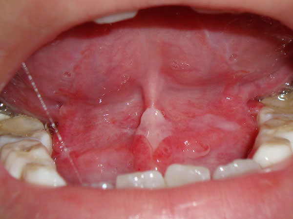 Figura 3 Lesiones de mucositis oral sublingual.