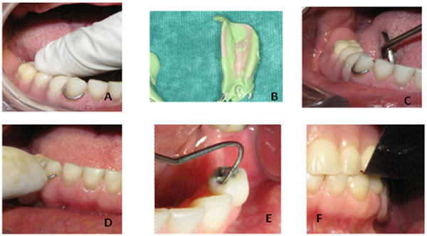 Figura 1 Evaluación de la aceptación clínica (A,B) soporte de la base; (C) extensión de la base; (D) retención; (D) forma de apoyo; (F) oclusión