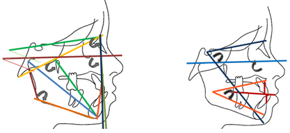 Fig 1. Planos, ejes y líneas de referencia: Base craneana anterior, (S-N), Ángulo SNA, Profundidad maxilar (Fh-NA), Longitud maxilar (Co-A), Plano de Frankfort (Po-Or), SNB, Longitud mandibular (Co-B), Plano Basocraneal (Ba- Na), Eje facial, Plano mandibular (Go-Me), Ángulo PlMn-Fh, Ángulo PlMn-SN, Ángulo PlMn-Fh, Ángulo PlMn-SN, 6. Altura facial inferior (ENA-Me). Eje Y ( SN/Gn), ENA-Xi-Pm, Wits.