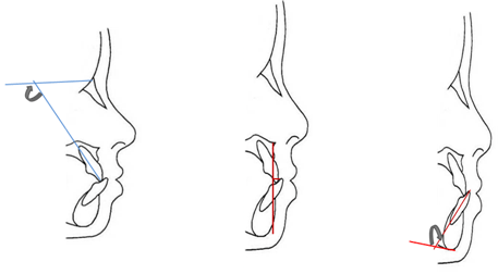Fig.2. Planos, ejes y líneas de referencia Ángulo (1NS), Distancia del borde incisal a la línea (A-Pog), Angulo1PlMn