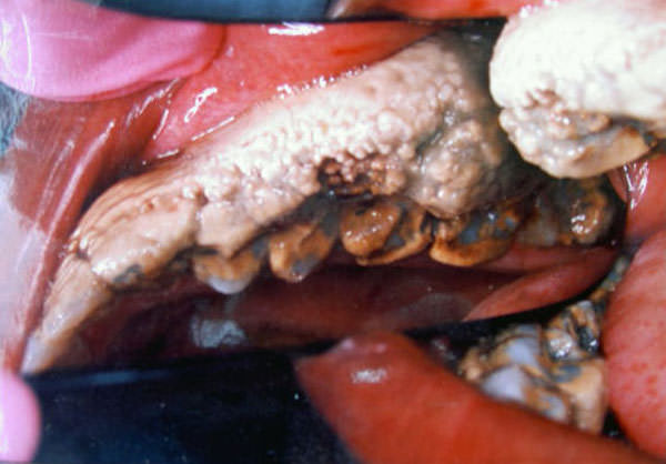 FIGURA 1 SE OBSERVA EL GRAN ACUMULO CALCAREO EN LA BOCA DEL PACIENTE QUE CUBRE CASI LA TOTALIDAD DE LA CARA VESTIBULAR Y PARTE DE LA OCLUSAL.
