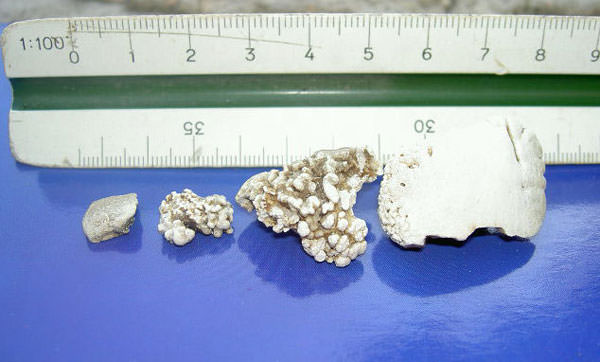 FIGURA 2 ESPECIMEN DEL CÁLCULO EN SECO YA RETIRADO DE LA BOCA DEL PACIENTE FRENTE A UNA REGLA A ESCALA.