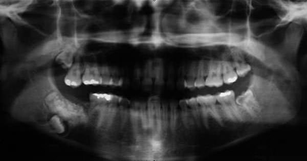 Figura 1 Radiografía panorámica. Se observa una extensa área radioopaca en la región del cuerpo y ángulo mandibular derecho, diente 48 orientado hacia la base de la mandíbula y el diente 47 ausente. Reabsorción interna en el diente 38.