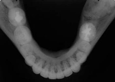 Figura 2 Radiografía oclusal total de la mandíbula. Presencia de ligero abultamiento en la cortical lingual del lado derecho.