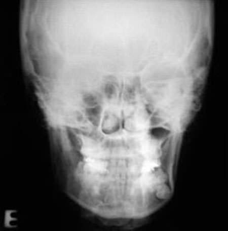 Figura 3 Radiografía postero-anterior de la mandíbula En el diente 3.8, fue observada la presencia de un área radiolúcida en la corona dentaria asintomática, sugiriendo una caries oculta.