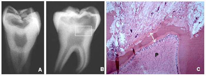 Figura 5 Aspectos radiográficos del diente aislado (A y B) y de la microscopia de la región más profunda y pulpar de la reabsorción dentaria externa (C) con preservación de la fina capa de dentina mineralizada y de la pré-dentina (fecha doble). Subyacente, la pulpa (P) preservó su organización estructural, especialmente en la capa odontoblástica, sin ningún infiltrado inflamatorio. Las lagunas de Howship son numerosas y no presentan clastos pues probablemente la reabsorción se encuentra inactiva en los cortes examinados.