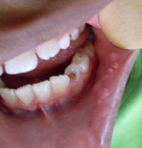 FIGURA 1 MÚLTIPLES PÁPULAS DE FORMA REDONDEADA, LOCALIZADAS EN TERCIO ANTERIOR DE MUCOSA YUGAL Y MUCOSA LABIAL INFERIOR LADO IZQUIERDO