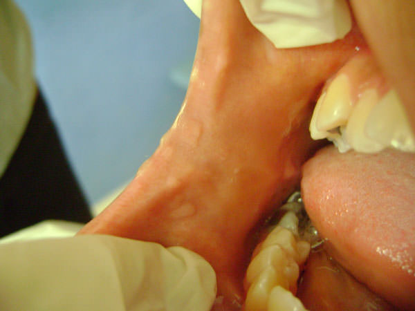 FIGURA 4 MÚLTIPLES PÁPULAS DE FORMA REDONDEADA, LOCALIZADAS EN TERCIO ANTERIOR DE MUCOSA YUGAL LADO DERECHO