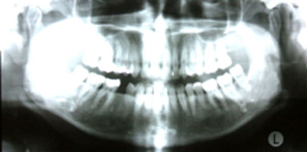 Fig 1 Radiografía panorámica