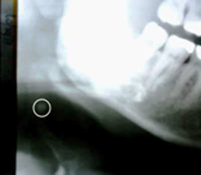 Fig 2 Lado Derecho