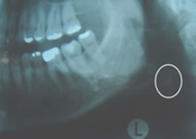 Fig 3 Lado izquierdo