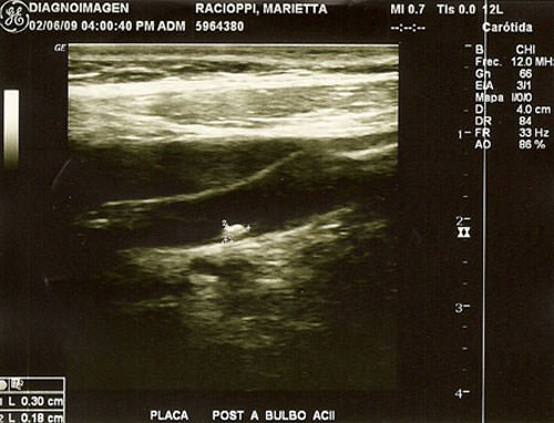 Fig 4 Eco doppler carótida izquierda