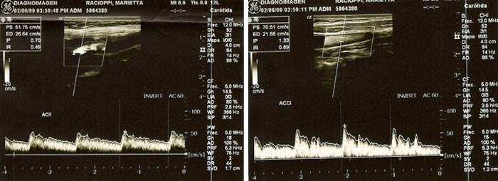 Fig 5 y 6 Patrón de flujo y parámetros hemodinámicos dentro de la normalidad