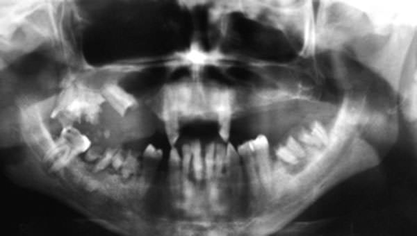 Figura 1 Radiografía panorámica pre-operatoria de la lesión envolviendo la hemi-maxila derecha.