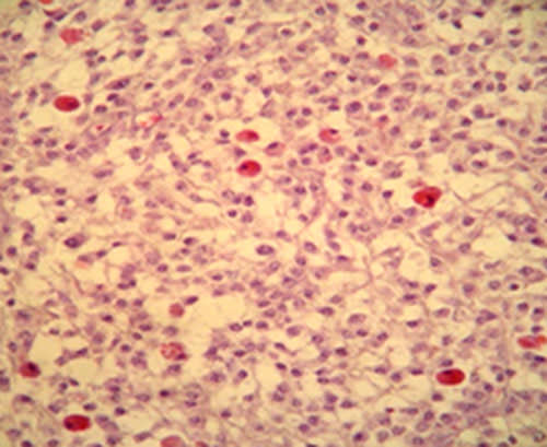 Figura 3 Trabécula ósea inmadura con proliferación de fibroblastos de núcleo globoso.