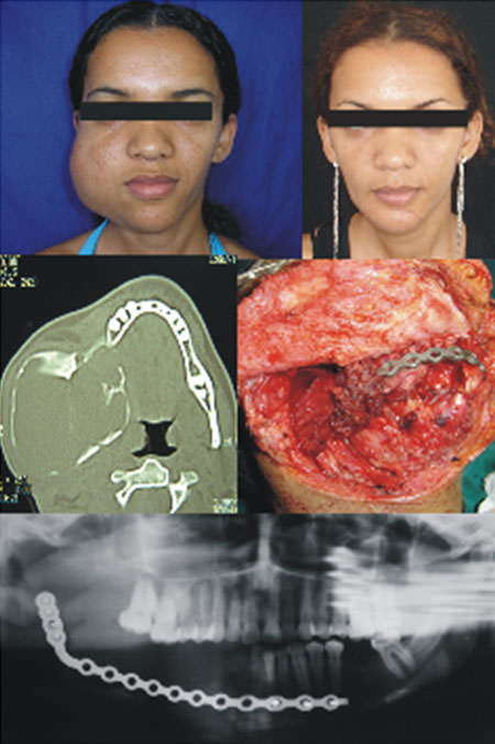 Figura 1 Paciente en pre y post tratamiento quirúrgico, imagen tomográfica de la extensión de la lesión, aspecto transquirúrgico con rotación de colgajo del músculo externocleidomastoideio, radiografía tras cirugía evidenciando placa de reconstrucción.