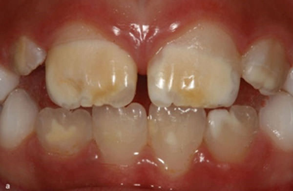 Figura 1 Hipomineralización de Incisivos y Molares en a: Incisivos com opacidades que varían del blanco a marrón, con fronteras bien definidas y límites claros con el esmalte normal y en b: primer molar gravemente afectado, presenta pérdida de la estructura