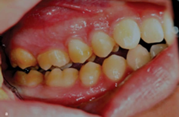 Figura 2 Amelogenesis Imperfecta en a: AI hipomaturada, caracterizada por opacidades demarcadas en grupos de dientes y en b: AI hipoplásica, caracterizado por la fina capa de esmalte en general
