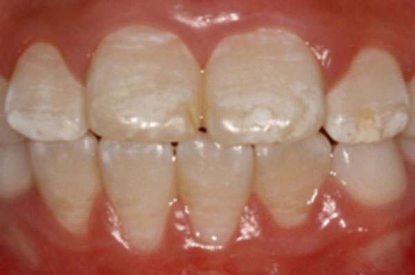 Figura 3 Fluorosis dental, caracterizado por opacidades blanco linear o difusa.