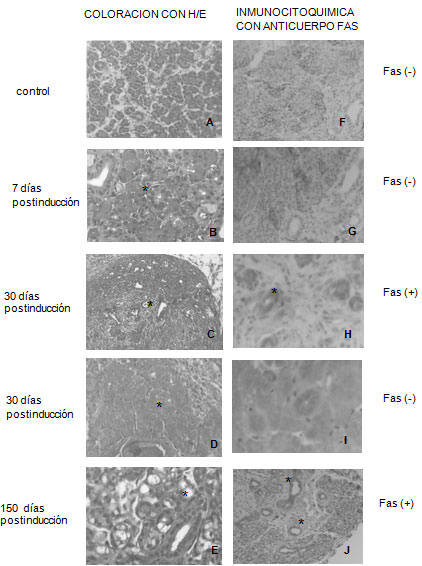 Figura 1 Glándula parótida de rata. A: Sin modificaciones ( aumento 200). B: Vacuolas en el citoplasma de las células acinares y conductos. Duplicación de capas celulares en los conductos (*) (aumento 400). C: crecimiento tumoral de tipo quístico; acúmulos de conductos intralobulillares sin presencia de acinos (*) (aumento 100). D: zona de necrosis por coagulación(*) (aumento 200). E: vacuolas en células acinares e hiperplasia epitelial ducta (*) (aumento 400) ; F :con inmunomarcación (-) (aumento 100) ; G: inmunomarcación (-) (aumento 200); H: 20% de los conductos la glándula parótida expresaron Fas (* (aumento 400); I: inmunomarcación (-) en zona de necrosis por coagulación (aumento 400) J: 70% de inmunomarcación (+)(*) (aumento 100).