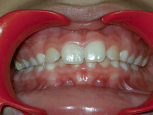 Foto 2 Oclusal de frente