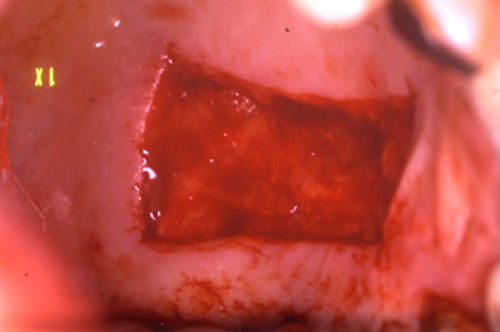 Figura 4 Región del paladar donador del injerto gingival libre.