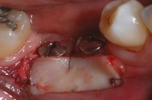 Figura 5 Injerto gingival libre adaptado y suturado en la región vestibular.