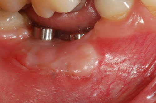 Figura 6 Cicatrización del injerto después de 45 días. Observe el aumento de la cantidad de mucosa queratinizada por vestibular.