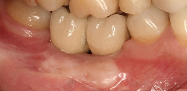 Figura 7 Cicatrización del injerto después de 3 meses. Observe las prótesis metal porcelana instaladas hace un mes y la ausencia de papila entre las coronas implanto soportadas.