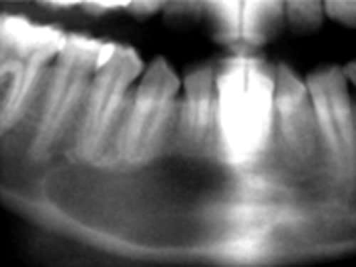 Figura 1 Imagen radiográfica que revela una zona de bordes definidos, bien delimitada que no afecta los ápices de las piezas vecinas y se proyecta entre ellos.