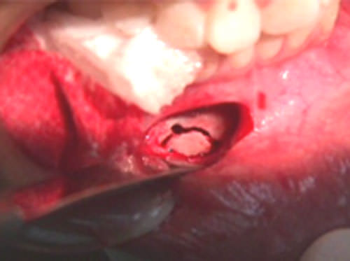 Figura 3 Luego de realizar la incisión se procedió a realizar una ventana ósea sobre la tabla vestibular.