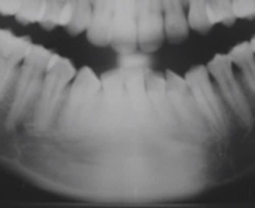Figura 6 Radiografía panorámica de control postoperatorio luego de dos años, donde se observa completa formación ósea.