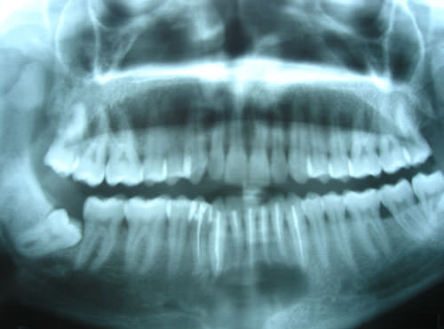 Figura 1 Rayos x panorámico preoperatorio (Caso 1).