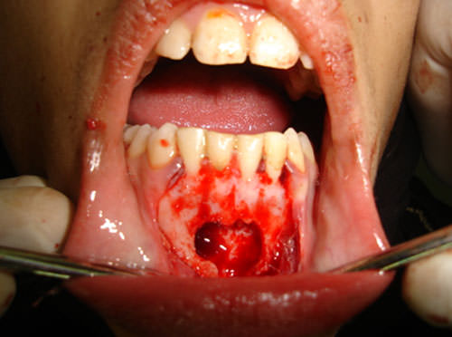 Figura 9 Defecto óseo una vez eliminado el quiste periapical. (Caso 2)