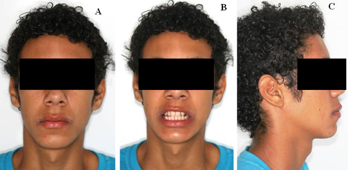 Figura 8 Fotos extrabucales: (A) foto de frente al termino de tratamiento con Herbst modificado, el paciente muestra musculatura labial mas armónica en reposo; (B) fotografía extrabucal del paciente sonriendo en tiempo 2 (T2), muestra mejoría del overbite del paciente; (C) foto de perfil mostrando la mejoría del perfil facial.