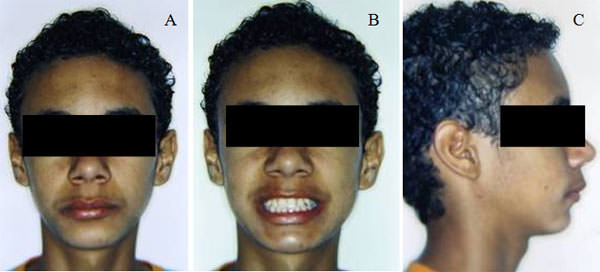 Figura 3 Fotografías faciales al inicio de tratamiento: (A) fotografía vista de frente del paciente; (B) fotografía extrabucal del paciente sonriendo ; (C) Fotografía de perfil.