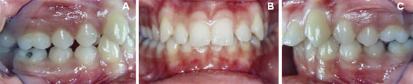 Figura 4 Fotografías intrabucales: (A) Lateral derecha, mostrando clase II molar y canina; (B) foto frontal, puede observar la sobremordida; (C) lateral izquierda, mostrando la clase II molar y canina.