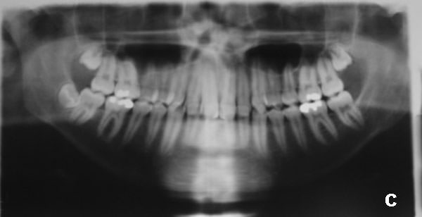 Figura 5 (A) Radiografía Carpal, mostrando que el paciente se encuentra pasando el pico de crecimiento puberal.  (B) Radiografía panorámica en T1 (tiempo 1).  (C) Telerradiografía en norma lateral T1.