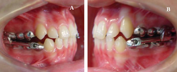 Figura 6 Fotografías intrabucales con avance mandibular ocasionado por el Herbst modificado: (A) lado derecho; (B) lado izquierdo.
