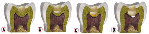 Figura 1 Representación esquemática de materiales de protección del complejo dentinopulpar de acuerdo con la profundidad de las cavidades para restauraciones con resina compuesta; A- Cavidad de media profundidad protegida solamente con sistema adhesivo; B- Cavidad profunda protegida con cemento ionómero de vidrio; C - Cavidad muy profunda protegida con cemento de hidróxido de calcio y cemento de ionómero de vidrio; D- Cavidad con exposición pulpar protegida con pasta de hidróxido de calcio, cemento de ionómero de vidrio y restaurada. Observar la pasta en contacto con la pulpa (1).