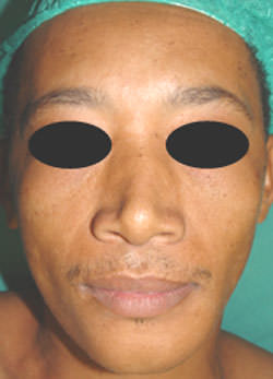 Foto Nº 1 Aspecto clínico mostrando el aumento de volumen del lado izquierdo del rostro