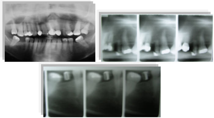 Figura 2 Rx Panorámica, Tomografía lineal maxilar superior e inferior.