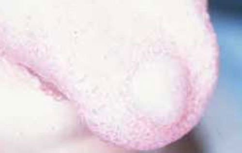 Figura 2 Imagen clínica. Mucocele en cara dorsal de la lengua. Tomado de Jiménez, 2002. (7).