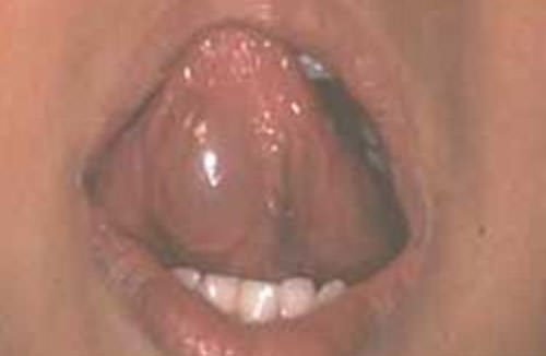 Figura 3 Imagen clínica. Mucocele en cara ventral de la lengua Tomado de Jiménez, 2002.(7).