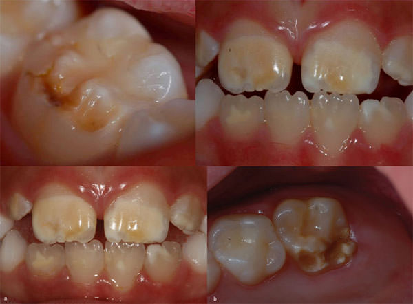 Figura 1 Hipomineralización de Incisivos y Molares en a: Incisivos com opacidades que varían del blanco a marrón, con fronteras bien definidas y límites claros con el esmalte normal y en b: primer molar gravemente afectado, presenta pérdida de la estructura