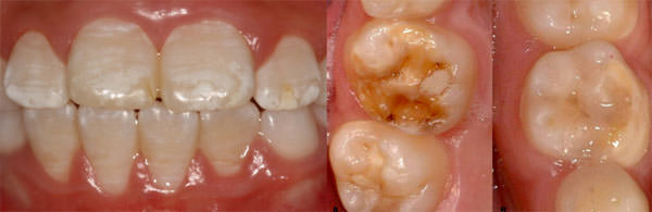 Figura 3 Fluorosis dental, caracterizado por opacidades blanco linear o difusa